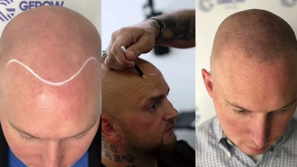 Best hairloss solution in NYC choosing Scalp Micropigmentation for lasting results
